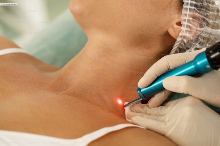 Which Is The Best Laser Tattoo Removal System?